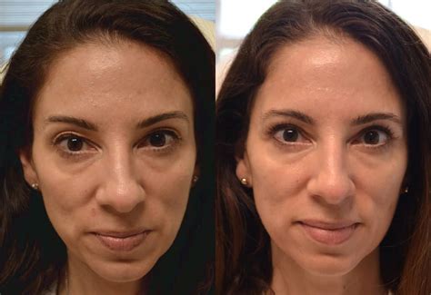 Upper Blepharoplasty Upper Eyelid Surgery And Lift New Jersey