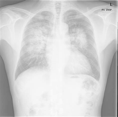 Chest Radiograph Pa View Showing Bilateral Perihilar Alveolar