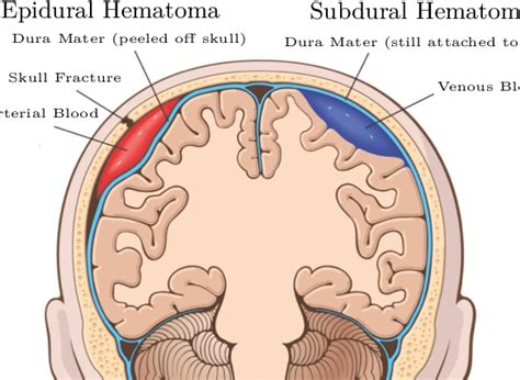 Anatomia Das Meninges E Hematoma Subdural