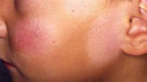 Causes Of Hypopigmentation Types And Treatment