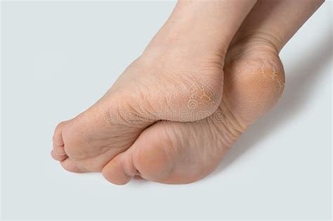 Rough Skin On Female Feet On Grey Background Dry And Cracked Soles Of Feet On White Background