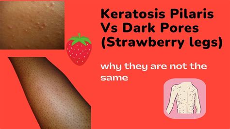 Keratosis Pilaris Vs Dark Pores Strawberry Legs Youtube