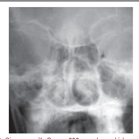 Figure 2 From Our Experiences With Congenital Midline Nasal Dermoid