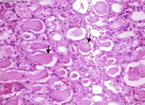 D Kidney Of Group Intratubular Eosinophilic Protein Cast Can Be Seen