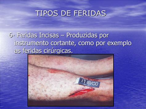As Feridas Oncológicas São Classificadas De Acordo Com
