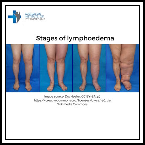 How Is The Severity Of Lymphoedema Defined Australian Institute Of