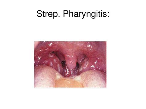 Ppt Otitis And Pharyngitis In Peds Chp 121 Tintinalli Powerpoint