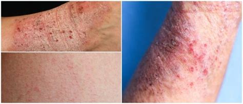 Eczema Types Of Eczema Causes Symptoms Diagnosis Evolution