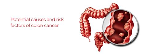 Potential Causes And Risk Factors Of Colon Cancer Bmchrc