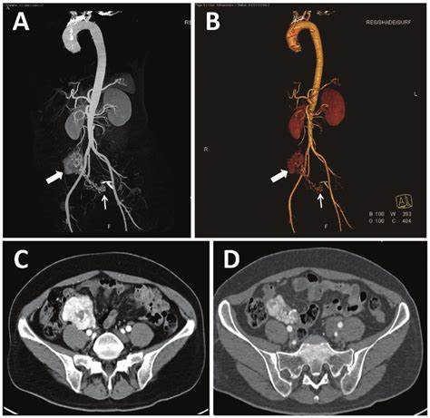 Computed Tomography Angiography Cta Of An Extra Adrenal Download