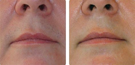 The conventional methods such as plucking stimulate the hair root to go into growing phase and results in thicker hair. Laser Hair Removal - Hayes Valley Medical & Esthetics