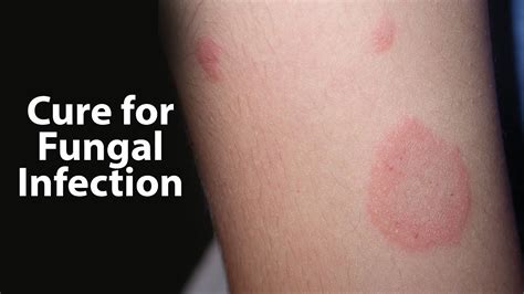 Yeast Fungal Skin Infection Skin Infection Pictures And Treatments Sometimes Under Certain