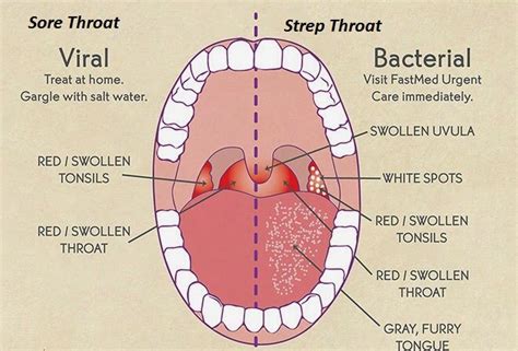 Sore Throat Causes Symptoms And Remedies How To Relief