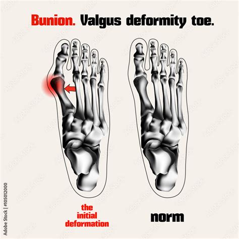 Bunion Valgus Deformity Toe Stock Vector Adobe Stock