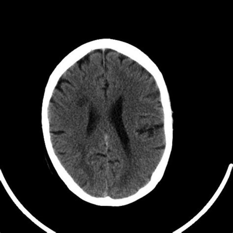 Mri Of Brain Showing Cerebellar Infarct Download Scientific Diagram