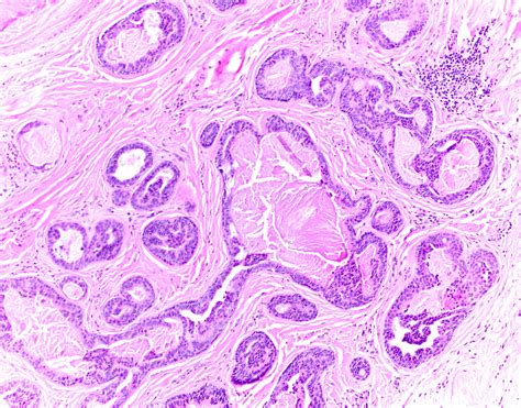 Pathology Outlines Papillary Eccrine Adenoma