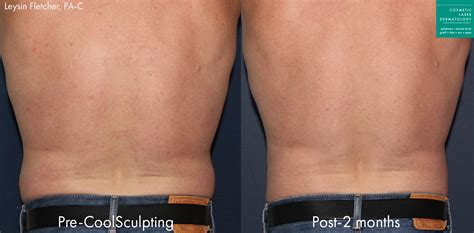 Reshape Your Quarantine 15 With Body Contouring Cosmetic Laser