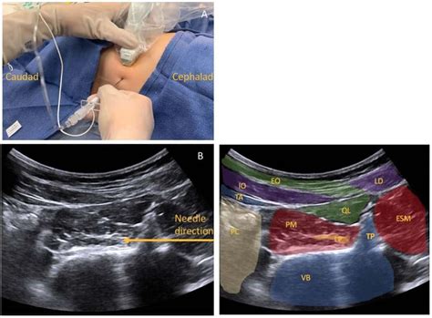Ultrasound Guided Lumbar Plexus Blocks In Paediatric Patients Wfsa
