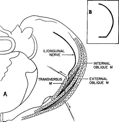 Entrapment Neuropathy Of The Ilioinguinal Nerve Nejm