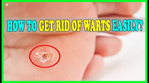 How To Get Rid Of Plantar Warts On Foot Naturally Best Home Remedies Youtube