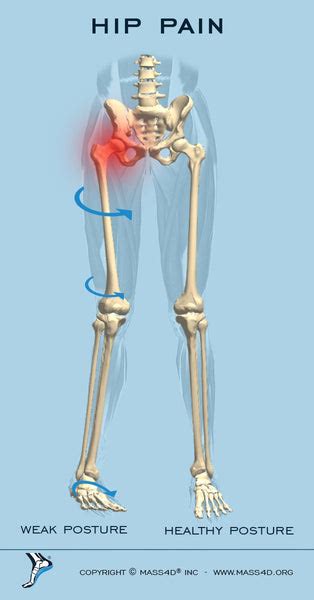 Can A Shorter Leg Cause Hip Pain