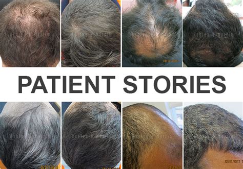 The ashley and martin perth consultants are jamie cole and rhonda davis and the doctor assisting our perth patients is dr mario terri. Ashley and Martin Perth - Hair Loss Treatment