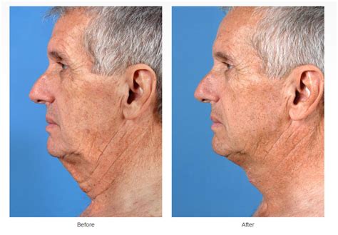 5 Reasons Neck Lift Surgery May Be Better Than Non Surgical Neck Lift