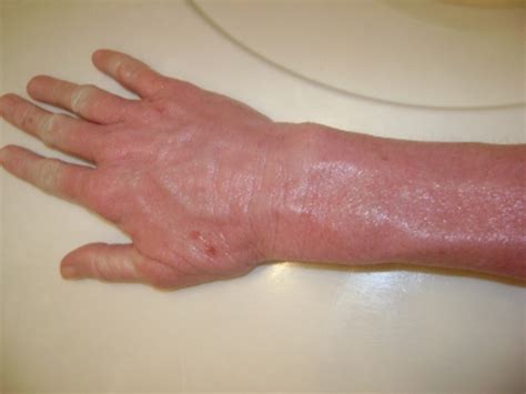 My Topical Steroid Withdrawal Red Skin Syndrome Story Hubpages