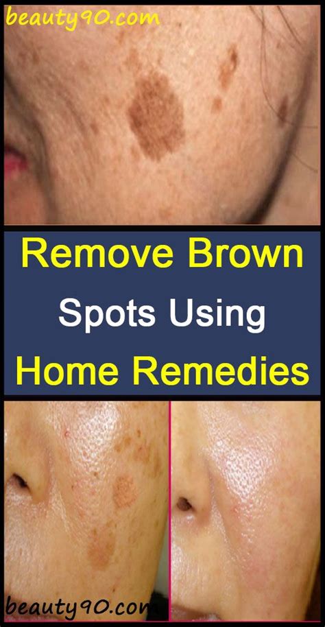 Pin On Best For Brown Spots On Face Bab