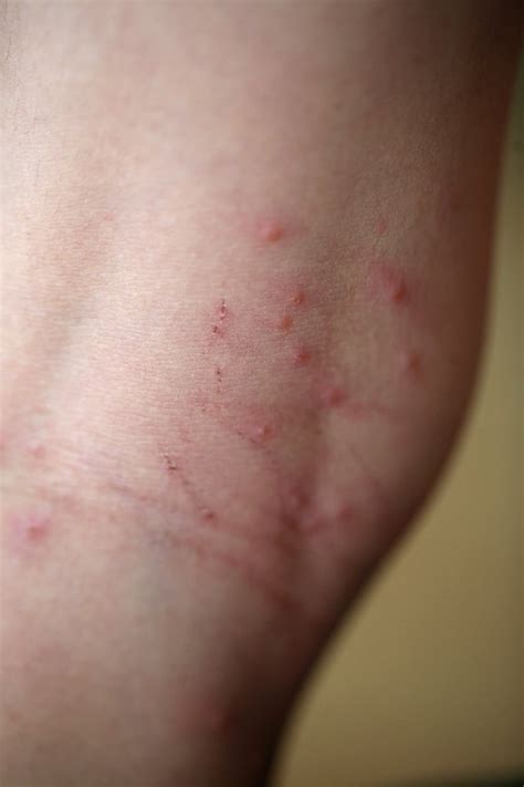 How Long Do Chiggers Live On Clothes Sante Blog