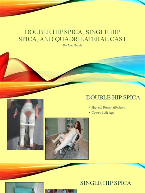 Double Hip Spica Single Hip Spica And Quadrilateral Cast Pdf
