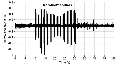 Korotkoff Sounds Recorded By A Microphone During The Cuff Deflation