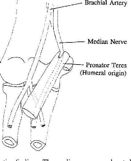 Figure 1 From Median Nerve Compression Within The Humeral Head Of