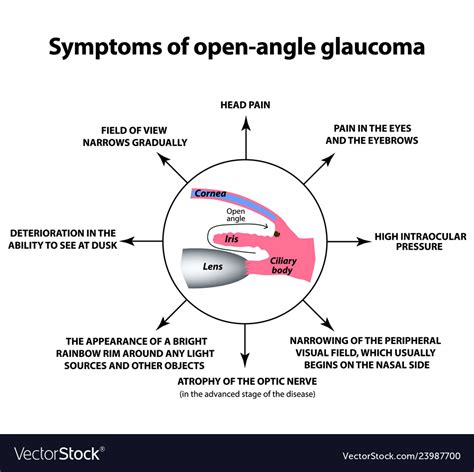 Symptoms Of Open Angle Glaucoma World Glaucoma Vector Image