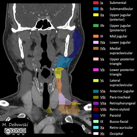 Level i cervical lymph nodes. Lymph node levels of the head and neck (annotated CT ...