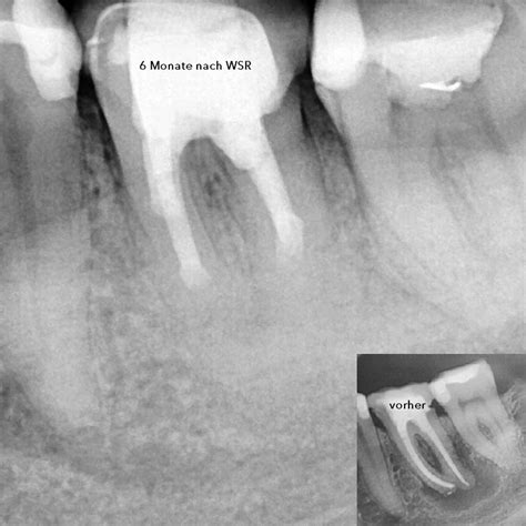 Wurzelspitzenresektion Zur Rettung Des Zahns Oralchirurgie Berlin