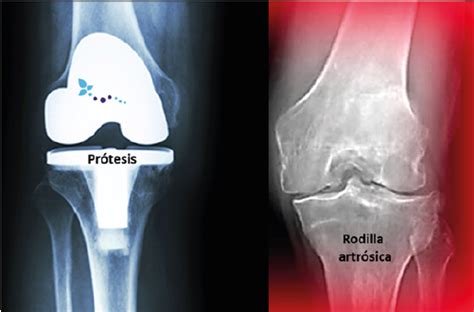 Cirugía De Prótesis De Rodilla Ortopedia Y Alta Especialidad Deportiva