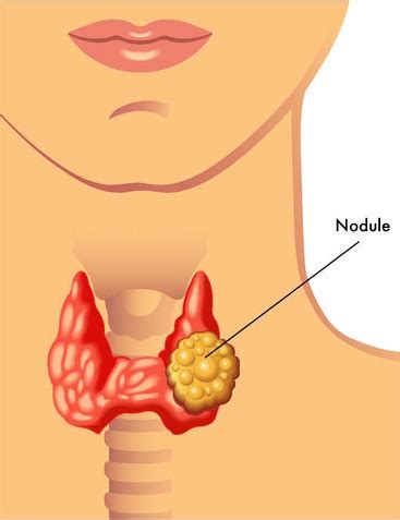 What thyroid nodules are and why they happen. Radioactive Iodine Risks in Thyroid Cancer Patients ...