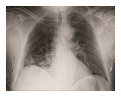 Chest Radiography Shows An Enlarged Cardiac Silhouette Download
