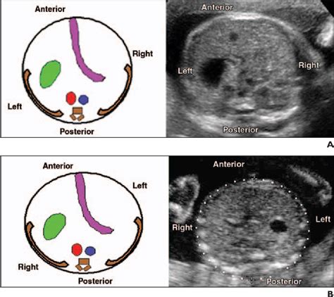 A routine antenatal ultrasound performed between 18 and 22 weeks enables. Figure 4 from Ultrasound of fetal cardiac anomalies ...