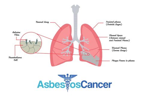 The symptoms of mesothelioma start in stage 3 or 4. mesothelioma end of life symptoms #Mesothelioma ...
