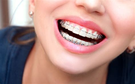 How Long Does It Take To Fix Overcrowded Teeth Boulderwoodgroup Blog