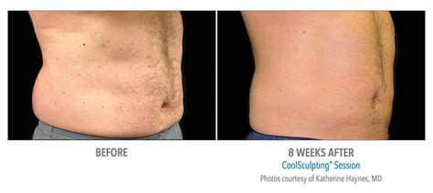 Coolsculpting® In Fairfield Nonsurgical Fat Elimination Without Downtime