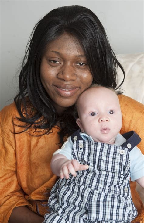Doctors define it as a congenital disorder (inborn) which hinders the human body from melanin creation. Meet The Black Parents Shocked When Their Son Was Born ...