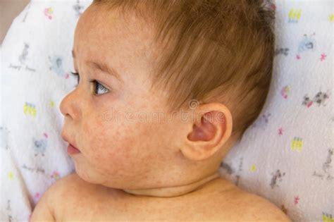 These hives can vary in size and can at times connect to create a more significant swelling. Baby With Dermatitis Problem Of Rash. Allergy Suffering ...