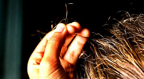 How To Deal With Trichotillomania And The Hair Loss As Its Result