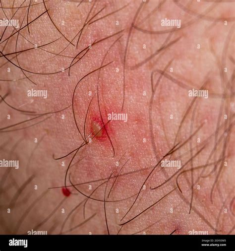 Small Pustules On The Skin Hi Res Stock Photography And Images Alamy