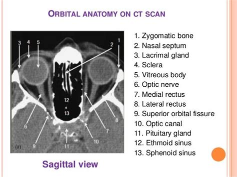 Image Result For Ct Scan Eyes Anatomy Orbit Anatomy Ct Scan