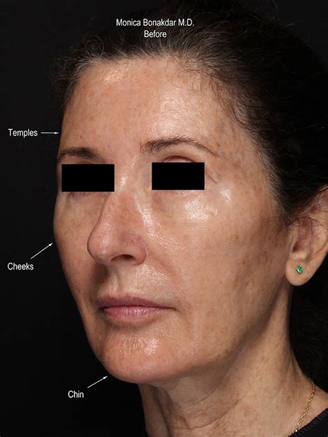Before And After Upper Face And Temples Procedures In Newport Beach Ca