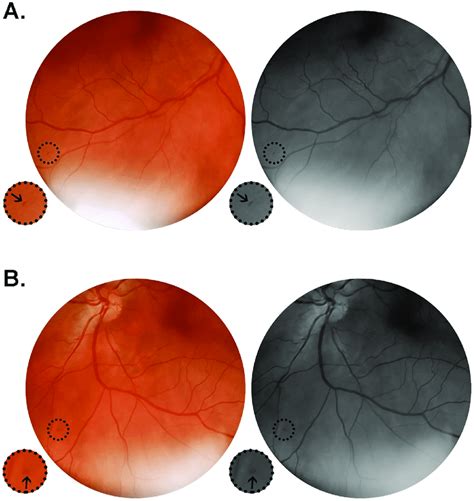 Color And Red Free Retinal Photographs From Patient 19 Gcx